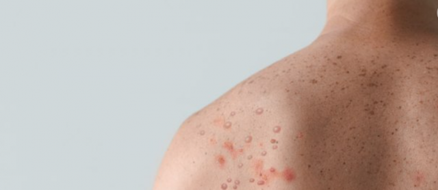 Muškarac pozitivan na koronu, HIV i majmunske boginje istovremeno